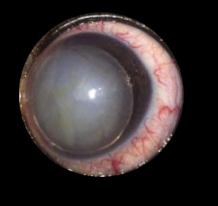eye with glaucoma
